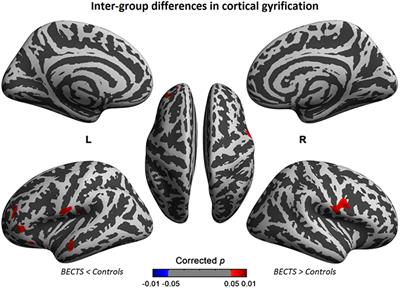 Structural Covariance Network of Cortical Gyrification in Benign Childhood Epilepsy with Centrotemporal Spikes